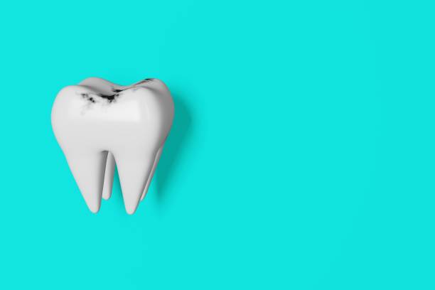 istock Caries tooth model 3D render Sick unhealthy molar blue background banner Dental tartar hygiene plaque enamel whitening 1421606662