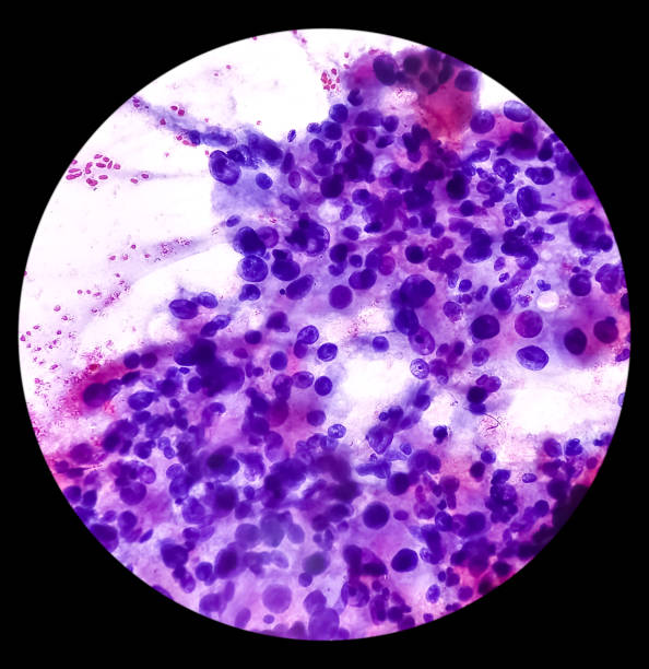 intra abdominal mass(cytology): spindle cell sarcoma, positive malignant cells. pleomorphic undifferentiated sarcoma, malignant fibrous histiocytoma. - morphology imagens e fotografias de stock