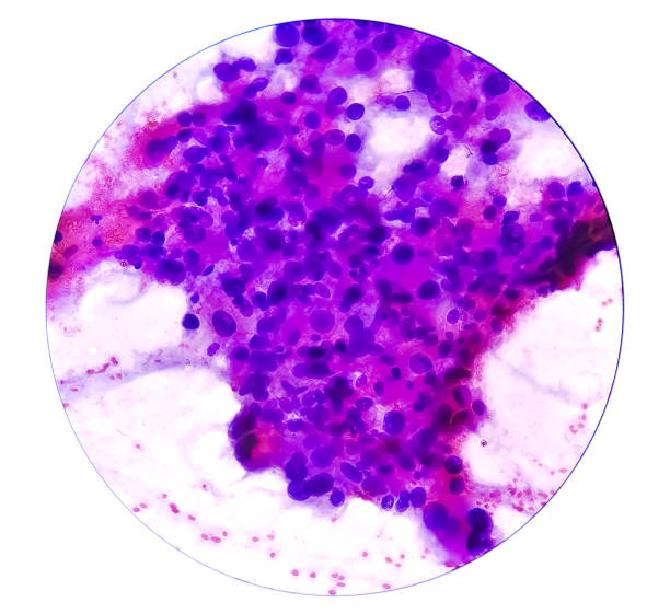 istock Cytological study of intra abdominal mass suggestive Spindle cell sarcoma, positive for malignant cells. Pleomorphic undifferentiated sarcoma, malignant fibrous histiocytoma. 1421820432