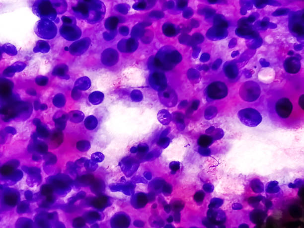 istock Cytological study of intra abdominal mass suggestive Spindle cell sarcoma, positive for malignant cells. Pleomorphic undifferentiated sarcoma, malignant fibrous histiocytoma. 1421820542