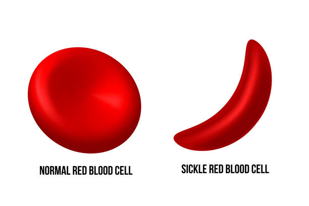 sichelzellenanämie. der unterschied von normalen roten blutkörperchen und sichelzellen. - sickle cell anemia red blood cell blood cell anemia stock-grafiken, -clipart, -cartoons und -symbole