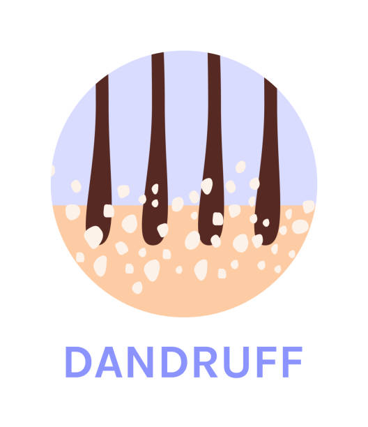 Oily dandruff treatment