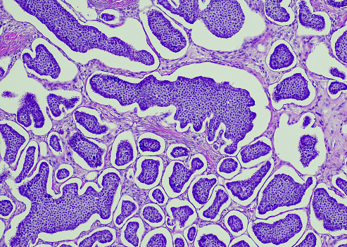 Breast tissue adenocarcinoma immunohistochemistry. Estrogen receptors.