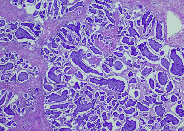 tumor carcinoide - ovary human cell cell high scale magnification fotografías e imágenes de stock