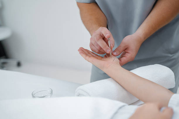 la main du médecin effectue un traitement d’acupuncture professionnel dans un spa de beauté sur le corps de la femme - acupuncturist photos et images de collection