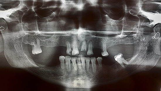 panoramic x-ray of mouth.