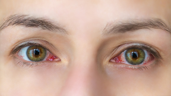 Close-up of a young woman with red eyes. Conjunctivitis, sore eyes
