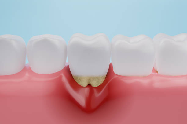 gum disease gingival recession - gums imagens e fotografias de stock