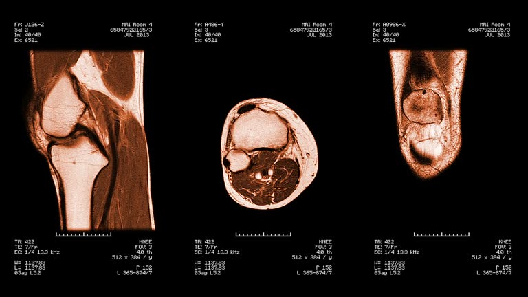 Knee Scan 220+ Mri Scan Knee Stock Videos and Royalty-Free Footage - iStock