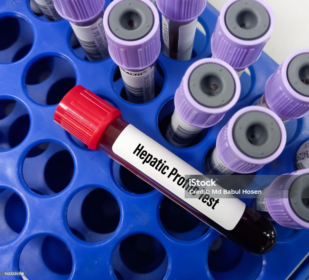 Sample Profile Pics Testing Blood Sample For Hepatic Profile Test Liver Function Panel Stock Photo ...