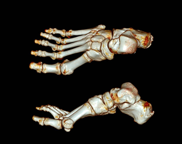 istock Computed Tomography of the Foot 1422442716