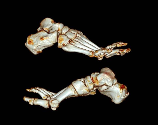 istock Computed Tomography of the Foot 1422442764