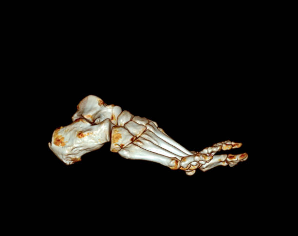 istock Computed Tomography of the Foot 1422442797