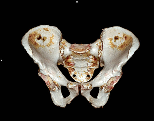istock CT scan of Pelvic bone and hip joint 3D 1422443051
