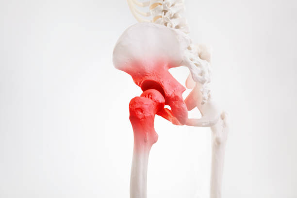 istock Hip bone pain, human skeleton hip arthritis 1422483593