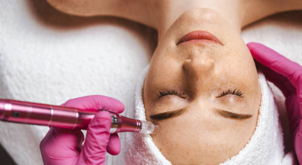 portrait en gros plan des mains d’esthéticienne cosmétologue faisant de la mésothérapie avec dermapen. procédure faciale à micro-aiguilles. cosmétologie professionnelle. - mesotherapy photos et images de collection