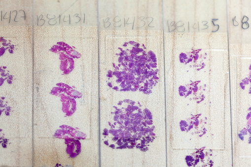 Stained tissue biopsy on glass slides in pathology laboratory