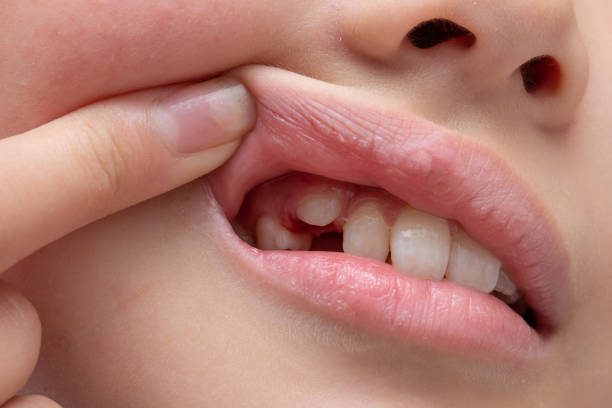 istock Mouth of a child with just missing teeth 1422783412