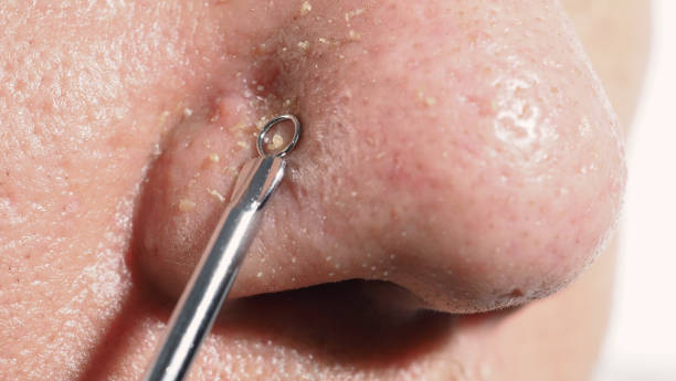 Acne and problem pores. Squeezing blackhead pimple with stainless steel medical acne remover tool. Pressing white and blackhead pimples from nose pores. Acne skin problem closeup. skin care treatment. acné y poros problemáticos. exprimir la espinilla de punto negro con una herramienta de eliminación de acné médica de acero inoxidable. prensando granos blancos y espinillas de espinillas de la nariz. primer plano del problema de la piel con acné. tr