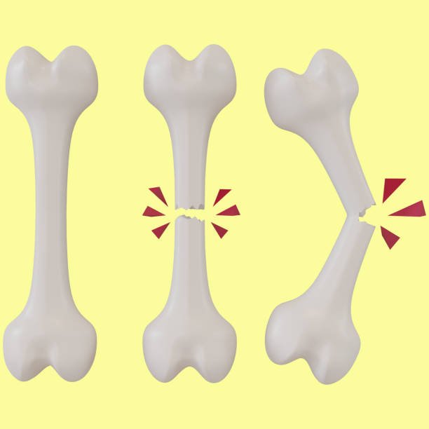 3d rendering of broken bones in different stages stock photo