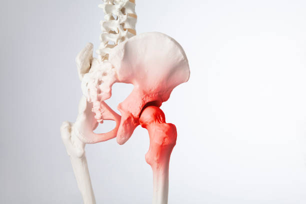 istock Hip bone pain, human skeleton hip arthritis 1423018646