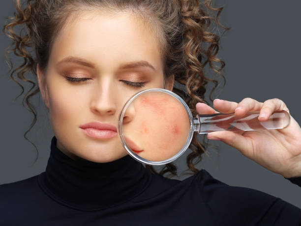 istock Post-Acne Marks .Treating Acne Scars.Acne Scar Removal 1423092702