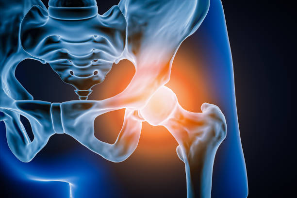 염증 또는 부상이있는 인간 고관절과 뼈의 전방 또는 정면 3d 렌더링 그림. 병리학, 관절 통증, 해부학, osteology, 류머티즘, 의료 및 건강 관리 개념. - hip replacement 뉴스 사진 이미지