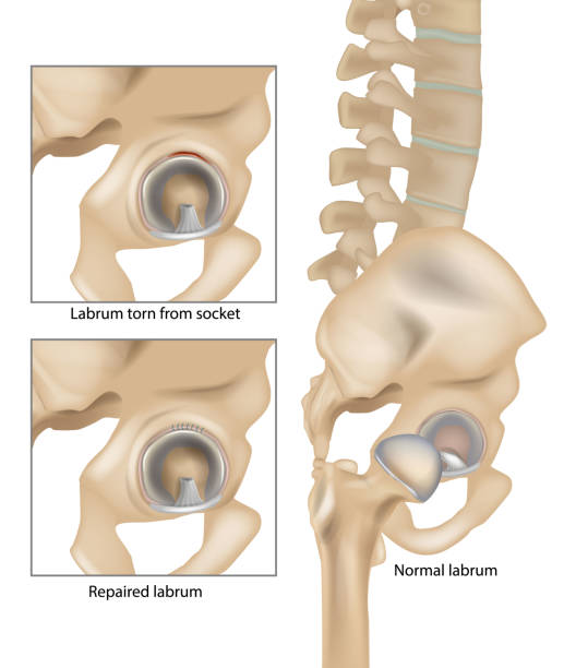 biodro łzy wargowe. labrum wyrwane z gniazda i naprawione labrum. operacja naprawy rozdartego biodra labralnego - biodro stock illustrations