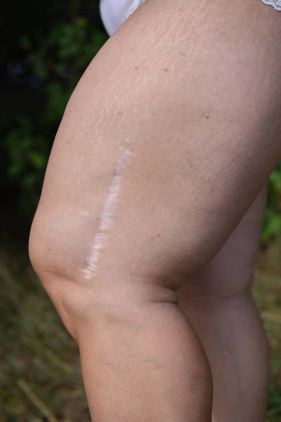 istock Scar on a woman's leg 1423188788