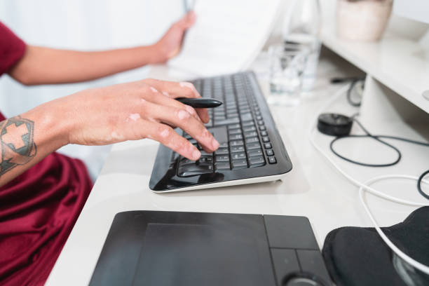Detail of young man's hands with vitiligo using computer.
