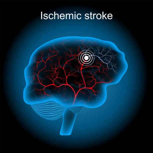 Cerebral infarction. ischemic stroke. human brain Cerebral infarction. ischemic stroke. human brain with blood vessel on dark background. Brain ischemia caused by a blood clot in an artery resulting in brain death to the affected area. vector illustration cerebrum stock illustrations