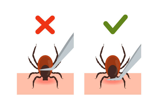 Removing encephalitis tick of skin after bite vector illustration isolated. Removing encephalitis tick of skin after bite, vector illustration isolated on white background. Infographic showing correct way to remove tick insect with tweezers. tick animal stock illustrations
