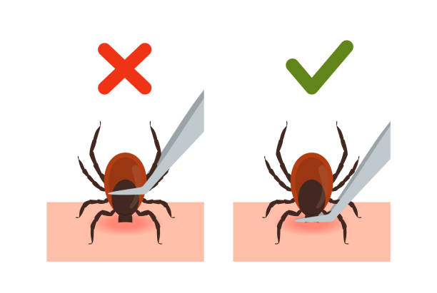 removing encephalitis tick of skin after bite vector illustration isolated. - 蜱 動物 幅插畫檔、美工圖案、卡通及圖標