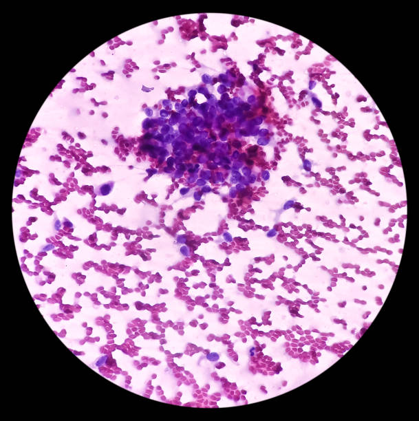istock Cytological study of knee joint swelling: Spindle cell neoplasm, smear show cellular material, mild pleomorphism, blood. 1423527029