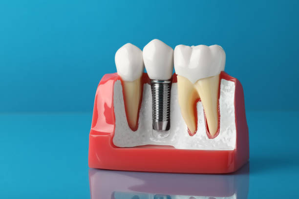 istock Educational model of gum with dental implant between teeth on light blue background 1423598326
