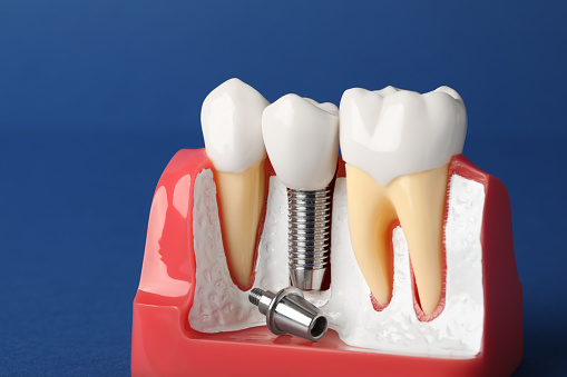 Educational model of gum with dental implant between teeth on blue background, closeup