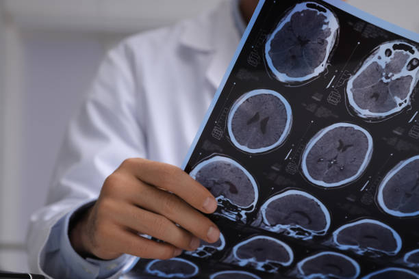 Doctor examining MRI images of patient with multiple sclerosis in clinic, closeup Doctor examining MRI images of patient with multiple sclerosis in clinic, closeup brain damage stock pictures, royalty-free photos & images