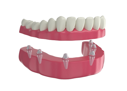 dental prosthesis, 6 overdenture implants, lower arch, 3d render