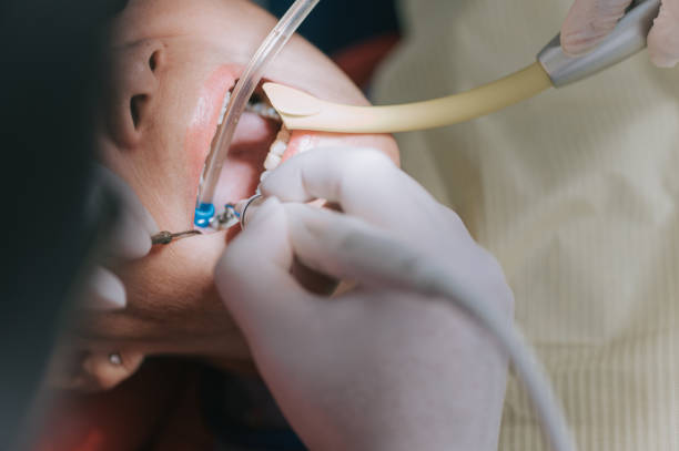 看護師が吸引チューブを持って開いた高齢女性患者の歯の口を修復するクローズアップ歯科医 - senior adult women adult tan ストックフォトと画像
