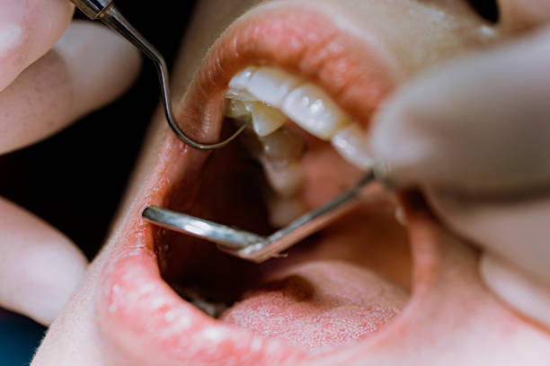 nahaufnahme asiatische chinesische patientin offener mund für zahnarzt, der ihre zahnroutineuntersuchung untersucht - zahnkaries stock-fotos und bilder