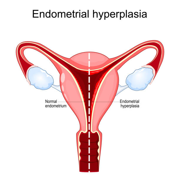 ilustrações, clipart, desenhos animados e ícones de hiperplasia hipófise - endometrial adenocarcinoma