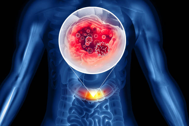 istock Colon cancer. Cancer attacking cell. Colon disease concept. 3d illustration 1424261432