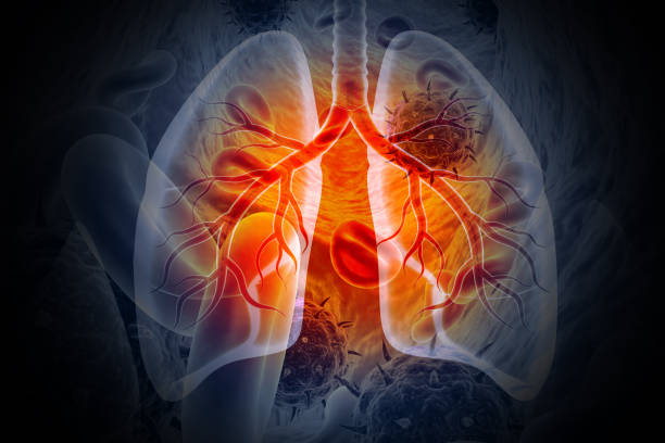 의료 배경에 폐암 또는 기관지 암종을 보여주는 의료 일러스트레이션, 3d 그림 - human lung asthmatic x ray human internal organ 뉴스 사진 이미지