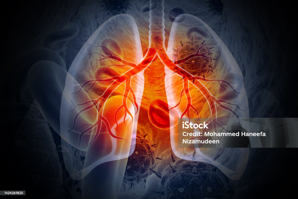 Medical Illustration showing lung cancer or bronchial carcinoma on medical background, 3d illustration Lung Cancer Stock Photo
