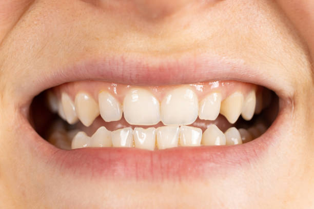 istock Patient with malocclusion, gap between upper and lower teeth, close-up mouth. 1424301489