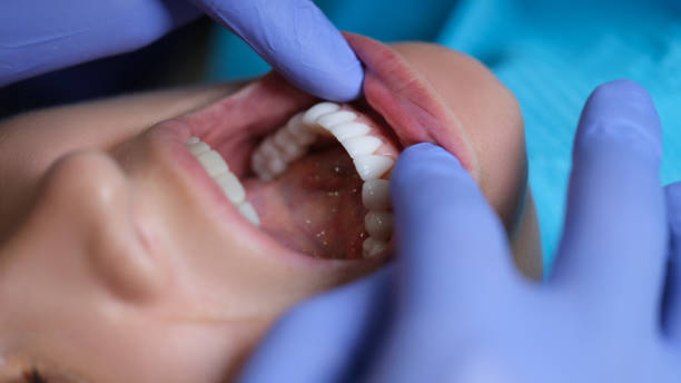 doctor dentist examining patient oral cavity with veneers closeup - caucasian cavity clinic color image imagens e fotografias de stock