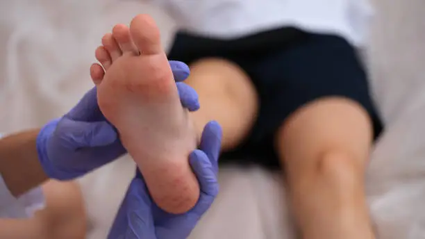 Infectious disease doctor examining rash on skin of child feet closeup. Ð¡oxsackie virus symptoms hand-foot-mouth concept