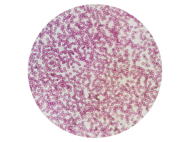 istock Microscopic view of hematological stained slide. thrombocytopenia. Extremely low level of platelet count in blood. 1424340189
