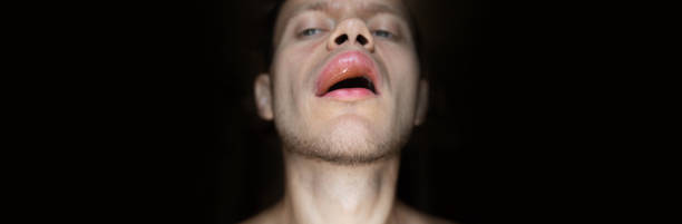 ふっくらとした唇、唇の上の男性の血管浮腫のアレルギー反応。唇の増強、カイロプラスティックス - 脂肪充填およびボトックス注射の概念 - angioedema ストックフォトと画像
