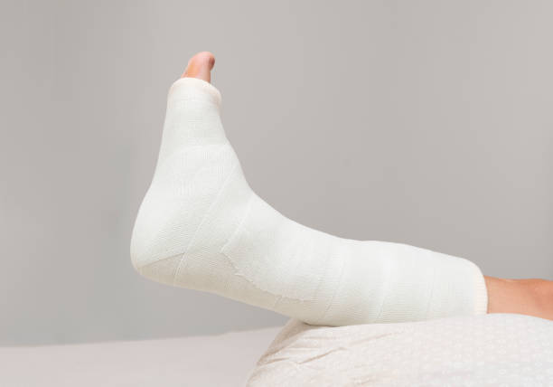 Broken leg. Ankle and foot splint Bandages on the legs. Broken leg. Ankle and foot splint Bandages on the legs. Close up broken leg stock pictures, royalty-free photos & images